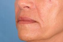 Hyaluronic Acid Before